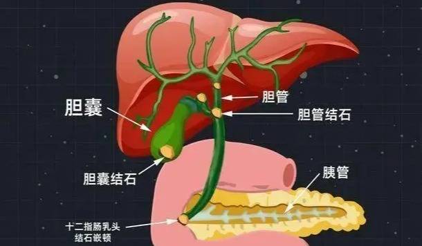 手机中病毒的症状:无明显症状的胆结石，生活中需要注意哪些？